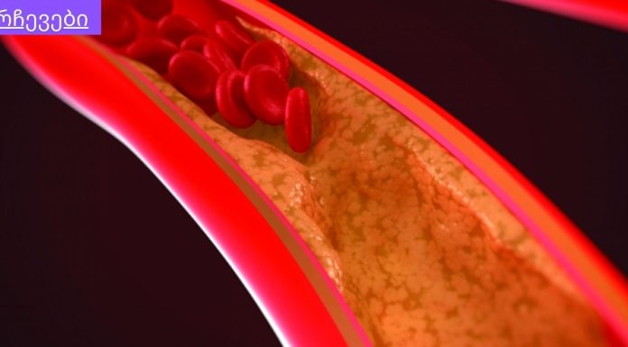 თრომბის “დაცობა” სწორეედ ამიტომ ხდება,ბევრმა არ იცის თრომბის გამომწვევი ერთ-ერთი მიზეზი,ათეროსკლეროზი,სიმპტომები,დაგნოსტიკა და მკურნალობა.
