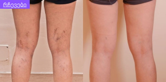 შეცდომები, რომლებიც იწვევს ვარიკოზულ ვენებს.რა ჩვევები უნდა გამოიმუშაოთ,რომ არ დაგემართოთ ვარიკოზული ვენების გაგანიერება.