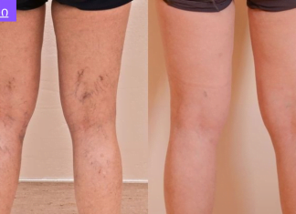 შეცდომები, რომლებიც იწვევს ვარიკოზულ ვენებს.რა ჩვევები უნდა გამოიმუშაოთ,რომ არ დაგემართოთ ვარიკოზული ვენების გაგანიერება.