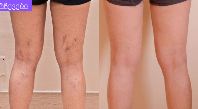 შეცდომები, რომლებიც იწვევს ვარიკოზულ ვენებს.რა ჩვევები უნდა გამოიმუშაოთ,რომ არ დაგემართოთ ვარიკოზული ვენების გაგანიერება.