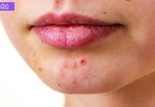 დაიღალეთ აკნესთან ბრძოლით? კურკუმა უნდა სცადოთ!