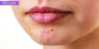 დაიღალეთ აკნესთან ბრძოლით? კურკუმა უნდა სცადოთ!