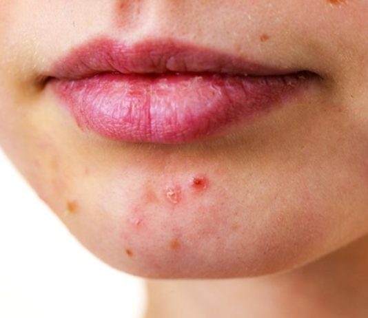 დაიღალეთ აკნესთან ბრძოლით? კურკუმა უნდა სცადოთ!