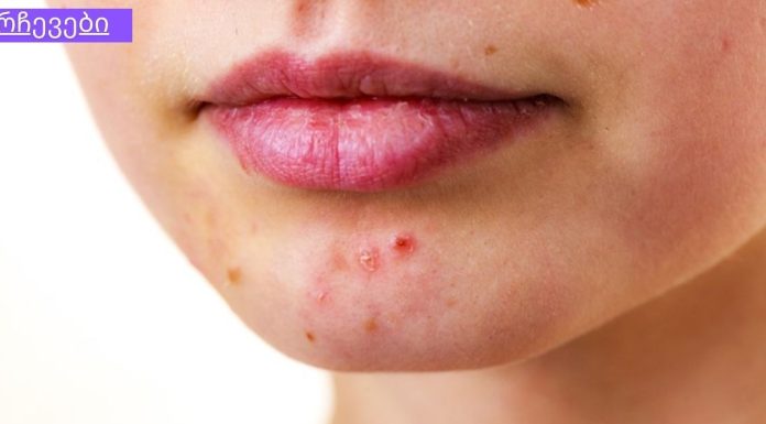 დაიღალეთ აკნესთან ბრძოლით? კურკუმა უნდა სცადოთ!