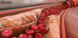 თუ გინდათ, რომ სისხლძარღვები სუფთა იყოს, როგორც ახალგაზრდობაში!გამოიყენეთ 5 მარტივი ტექნიკა
