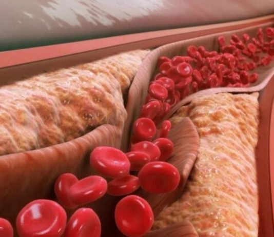 თუ გინდათ, რომ სისხლძარღვები სუფთა იყოს, როგორც ახალგაზრდობაში!გამოიყენეთ 5 მარტივი ტექნიკა