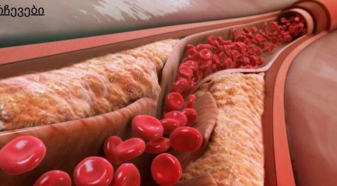 თუ გინდათ, რომ სისხლძარღვები სუფთა იყოს, როგორც ახალგაზრდობაში!გამოიყენეთ 5 მარტივი ტექნიკა