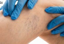 8 წესი, რომელიც უნდა დაიცვათ, თუ გსურთ განკურნოთ ვარიკოზული ვენები