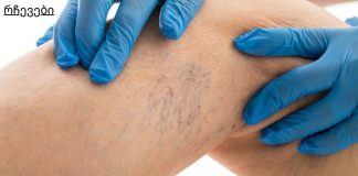 8 წესი, რომელიც უნდა დაიცვათ, თუ გსურთ განკურნოთ ვარიკოზული ვენები