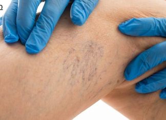 8 წესი, რომელიც უნდა დაიცვათ, თუ გსურთ განკურნოთ ვარიკოზული ვენები