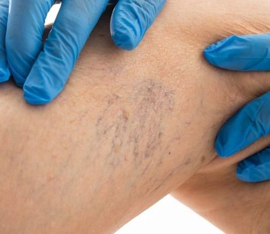 8 წესი, რომელიც უნდა დაიცვათ, თუ გსურთ განკურნოთ ვარიკოზული ვენები