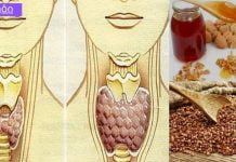 გადაუჭრელი პრობლრემა გგონიათ ჩიყვის პრობლემები? გაეცანით ამ სტატიას და იმკურნალეთ უმარტივესად.