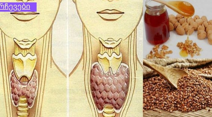 გადაუჭრელი პრობლრემა გგონიათ ჩიყვის პრობლემები? გაეცანით ამ სტატიას და იმკურნალეთ უმარტივესად.