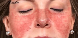 7 ნიშანი იმისა, რომ თქვენი კანი გაფრთხილებთ სერიოზულ დაავადებებზე