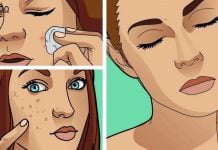 პაპილომების, ხალების, შავი წერტილების, ასაკობრივი ლაქების და მეჭეჭების მოსაშორებლად საუკეთესო საშუალებაა