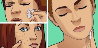 პაპილომების, ხალების, შავი წერტილების, ასაკობრივი ლაქების და მეჭეჭების მოსაშორებლად საუკეთესო საშუალებაა