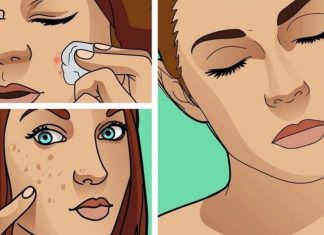 პაპილომების, ხალების, შავი წერტილების, ასაკობრივი ლაქების და მეჭეჭების მოსაშორებლად საუკეთესო საშუალებაა