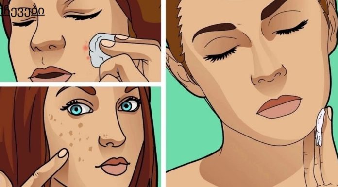 პაპილომების, ხალების, შავი წერტილების, ასაკობრივი ლაქების და მეჭეჭების მოსაშორებლად საუკეთესო საშუალებაა