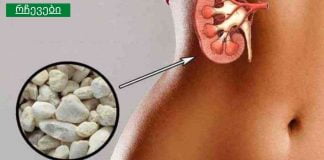 რეცეპტი თირკმელების ქვების დასაშლელად, რომელიც არაერთხელ იქნა გამოცდილი.