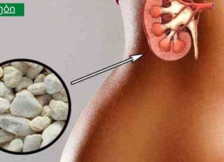 რეცეპტი თირკმელების ქვების დასაშლელად, რომელიც არაერთხელ იქნა გამოცდილი.