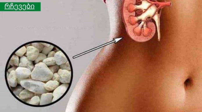 რეცეპტი თირკმელების ქვების დასაშლელად, რომელიც არაერთხელ იქნა გამოცდილი.