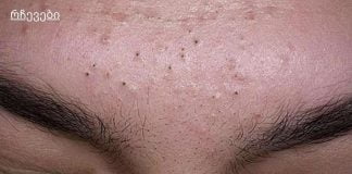 7 რჩევა შავი წერტილებისგან სწრაფად მოსაშორებლად