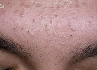 7 რჩევა შავი წერტილებისგან სწრაფად მოსაშორებლად