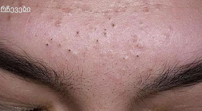 7 რჩევა შავი წერტილებისგან სწრაფად მოსაშორებლად