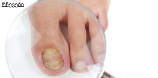 მსოფლიო მოსახლეობის 75% ეს აწუხებს. ფეხის ფრჩხილის სოკოს 4 საშინაო საშუალება.ყველაზე იაფი მეთოდია.