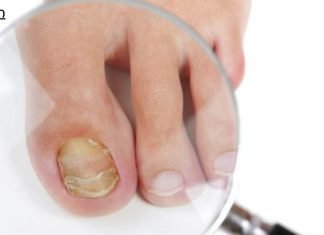 მსოფლიო მოსახლეობის 75% ეს  აწუხებს. ფეხის ფრჩხილის სოკოს 4 საშინაო საშუალება.ყველაზე იაფი მეთოდია.