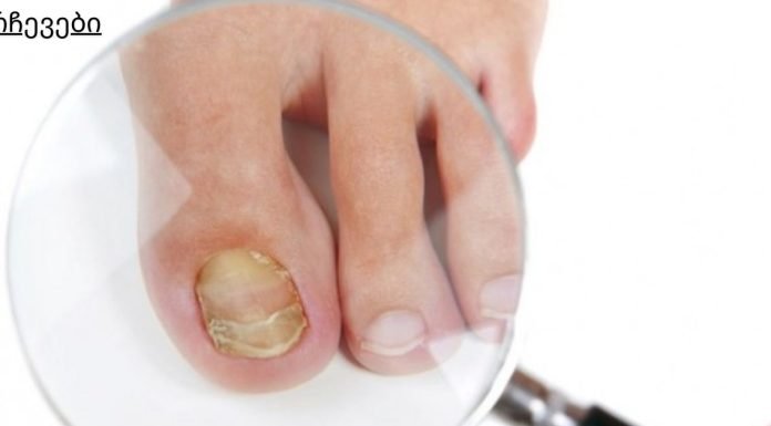 მსოფლიო მოსახლეობის 75% ეს აწუხებს. ფეხის ფრჩხილის სოკოს 4 საშინაო საშუალება.ყველაზე იაფი მეთოდია.