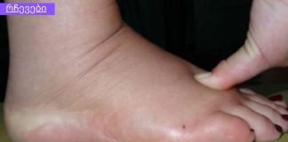 5 სიმპტომი იმისა, რომ ორგანიზმში სითხე გაქვთ შეკავებული