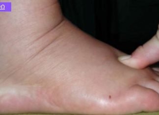 5 სიმპტომი იმისა, რომ ორგანიზმში სითხე გაქვთ შეკავებული