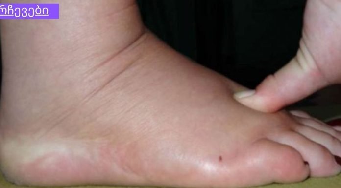 5 სიმპტომი იმისა, რომ ორგანიზმში სითხე გაქვთ შეკავებული