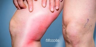 სხეულში სისხლის შედედების საშიში ნიშნები, რამაც შეიძლება მყისიერად მოგკლას