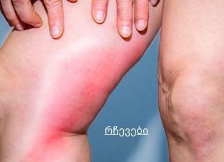 სხეულში სისხლის შედედების საშიში ნიშნები, რამაც შეიძლება მყისიერად მოგკლას
