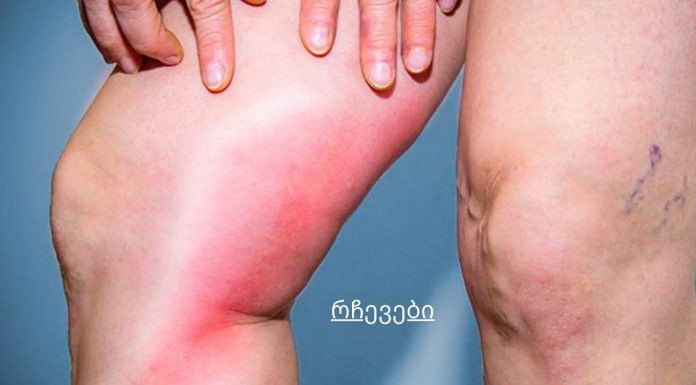 სხეულში სისხლის შედედების საშიში ნიშნები, რამაც შეიძლება მყისიერად მოგკლას