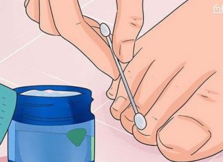 ექვსი ძლიერი საშუალება ხფრჩხილის სოკოს მოსაშორებლად