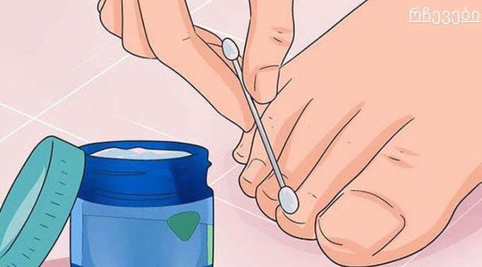 ექვსი ძლიერი საშუალება ხფრჩხილის სოკოს მოსაშორებლად