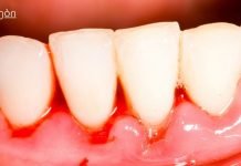 ღრძილების სისხლდენის მკურნალობა ბუნებრივი საშუალებებით.