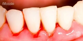 ღრძილების სისხლდენის მკურნალობა ბუნებრივი საშუალებებით.