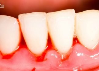 ღრძილების სისხლდენის მკურნალობა ბუნებრივი საშუალებებით.