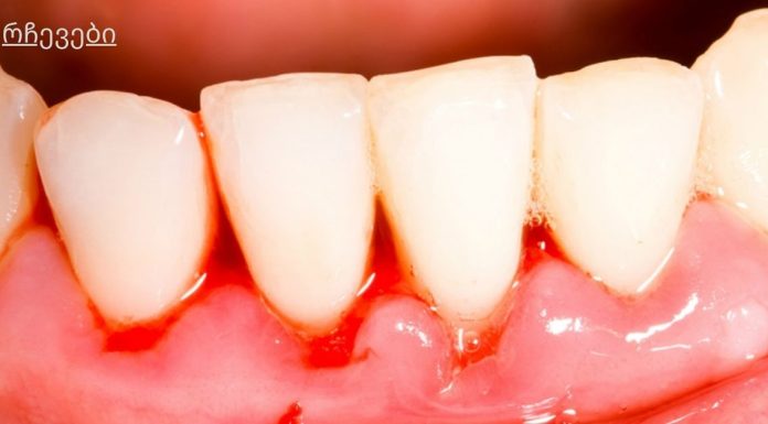 ღრძილების სისხლდენის მკურნალობა ბუნებრივი საშუალებებით.