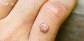 მეჭეჭების მოშორების ხალხური საშუალებები.