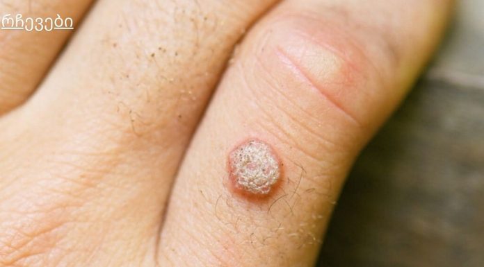 მეჭეჭების მოშორების ხალხური საშუალებები.