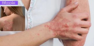 ყველაფერი რაც თქვენ უნდა იცოდეთ ფსორიაზის შესახებ! ნუ გეშინია – ჩვენ შეგვიძლია გავუმკლავდეთ ამას