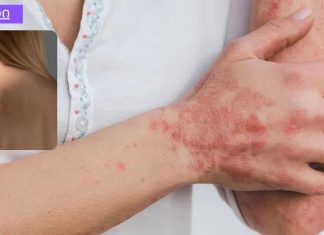 ყველაფერი რაც თქვენ უნდა იცოდეთ ფსორიაზის შესახებ! ნუ გეშინია – ჩვენ შეგვიძლია გავუმკლავდეთ ამას