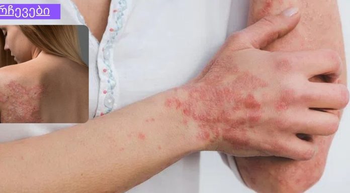 ყველაფერი რაც თქვენ უნდა იცოდეთ ფსორიაზის შესახებ! ნუ გეშინია – ჩვენ შეგვიძლია გავუმკლავდეთ ამას