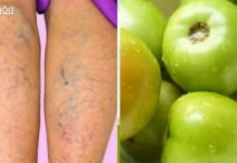 შესანიშნავი ფარული საშუალება, რომელიც ყველას გვაქვს სახლში და რომელიც შეგიძლიათ ვარიკოზული ვენების მკურნალობა!