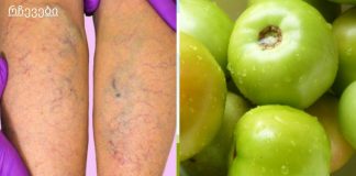 შესანიშნავი ფარული საშუალება, რომელიც ყველას გვაქვს სახლში და რომელიც შეგიძლიათ ვარიკოზული ვენების მკურნალობა!